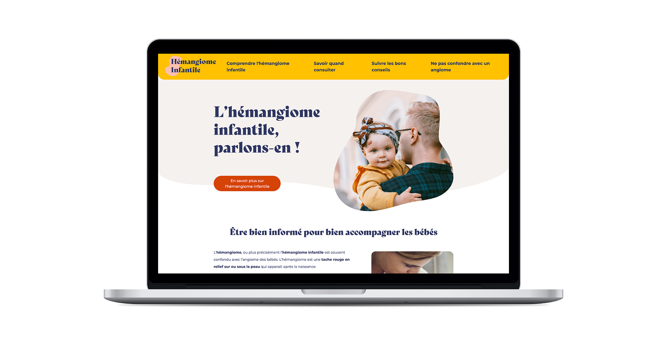 Accueil du site internet Hémangiome Infantile